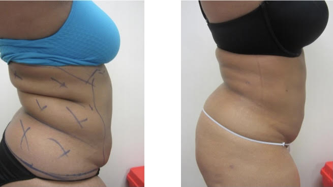 Liposuction 8 weeks later Drew Varano MD Liposuction 8 weeks later Drew Varano MD